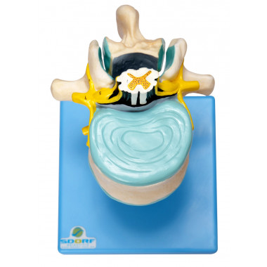 Vértebra Lombar C/ Cordão Espinhal, Nervo e Cauda Equina