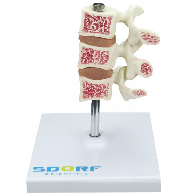 Modelo de Osteoporose