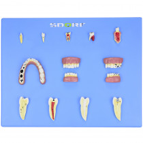 Modelo de Patologias Dentárias c/ 12 Partes em Placa  Modelo de Patologias Dentárias c/ 12 Partes em Placa