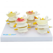 Modelo Degenerativo Evolutivo das Vértebras em 4 partes Modelo Degenerativo Evolutivo das Vértebras em 4 partes