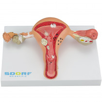 Modelo Patológico do Útero Modelo Patológico do Útero