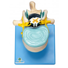 Vértebra Lombar C/ Cordão Espinhal, Nervo e Cauda Equina