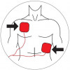 Eletrodo tipo pá Adulto para Desfibrilador Cardioversor Original Instramed