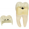 Dente Molar Inferior c/ Raiz Dupla em 3 Partes c/ Cárie, 8x o Tamanho Real Aprox.