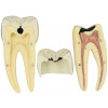 Dente Molar Inferior c/ Raiz Dupla em 3 Partes c/ Cárie, 8x o Tamanho Real Aprox.