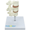 Modelo de Osteoporose