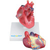 Modelo Patológico do Coração com Hipertrofia em 2 Partes