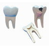 Dente Molar Ampliado - Saudável e com Cáries Modelo Anatômico